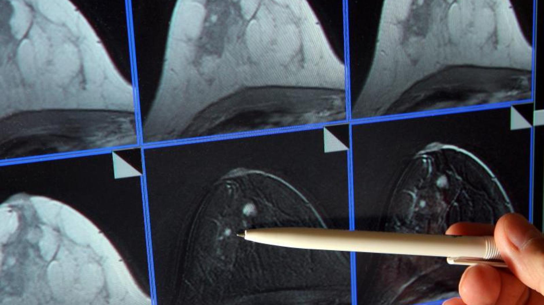 33++ Brustkrebs bilder nach op , Brustkrebs Studie Krebsrisiko steigt wohl durch Aluminium in Deo